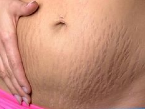 إزالة التشققات