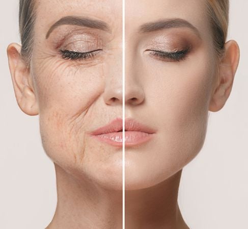 القضاء على التجاعيد