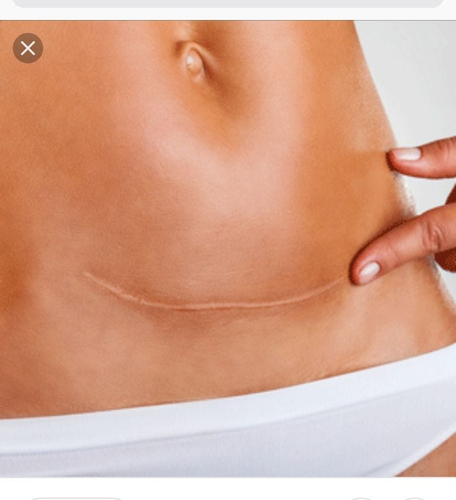 إخفاء ندبات العمليات