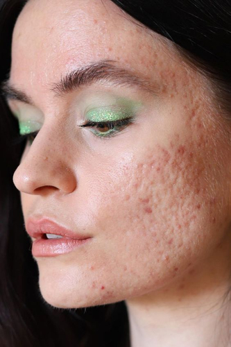 جلسة ندبات الوجة